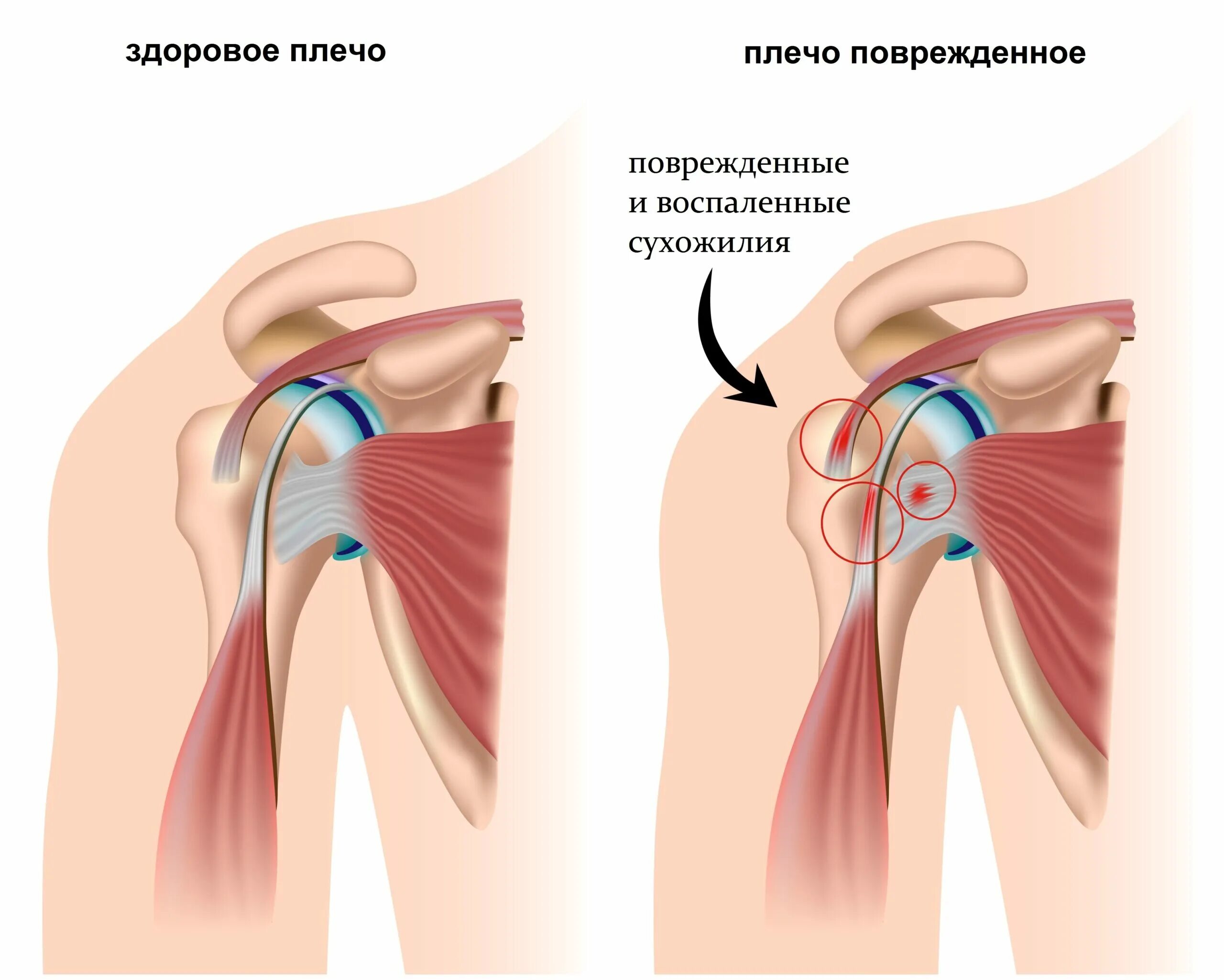 Болит плечо при поднятии. Лопаточно-плечевой периартрит. Импиджмент плечевого сустава. Вращательная манжета плечевого сустава. Синдром плечелопаточный периартрит.