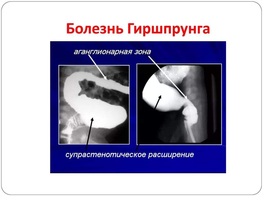 Болезнь гершпрунга у взрослых. Врождённый мегаколон (болезнь гиршпрунга. болезнь гиршпрунга рентгенограмма. болезнь гиршпрунга рентген.