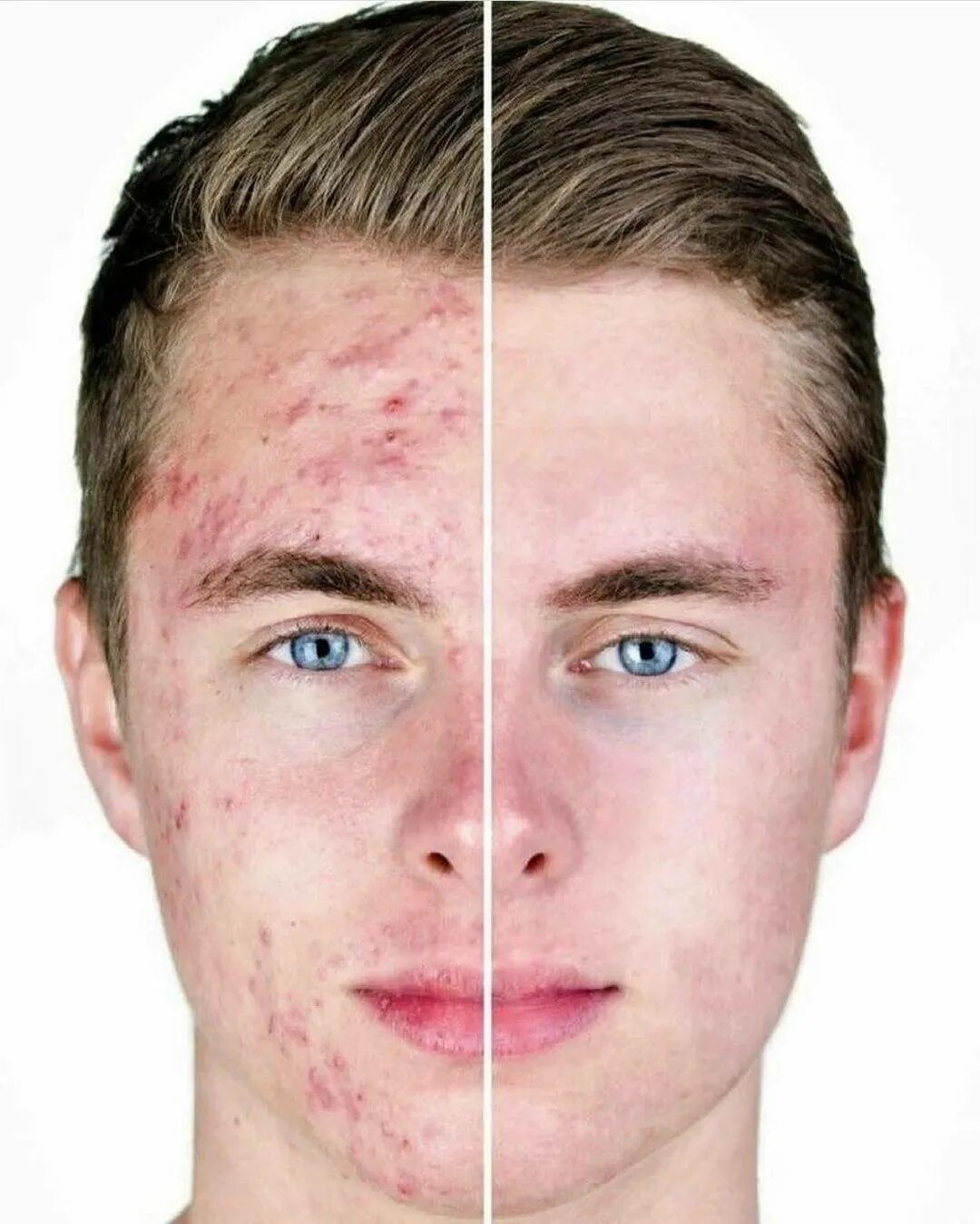 Папуло пустулезные акне. Почему летом прыщи. Почему летом прыщи. Почему летом прыщи. Почему летом прыщи.