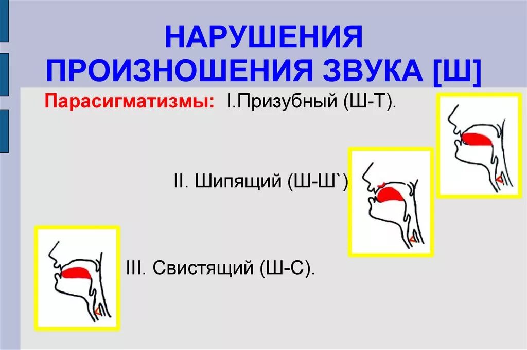 Нарушение произношения свистящих звуков. Нарушение произношения шипящих. Нарушение произношения звука ш. Нарушенное произношение шипящих звуков. Ш как произносится