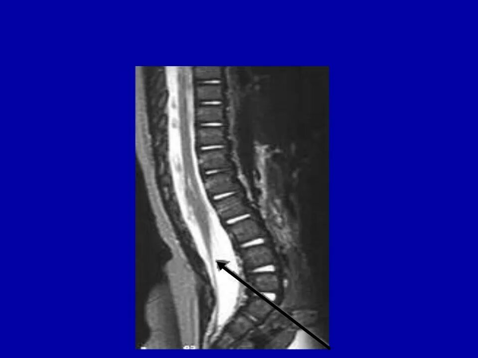 Липома терминальной нити синдром фиксированного спинного мозга. Липома спинного мозга мрт. Конус спинного мозга мрт. Киста конуса спинного мозга мрт.