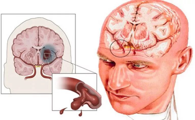 Поражение головного мозга при инсульте. Геморрагический инсульт с кровоизлиянием в головной мозг. ОНМК ишемический и геморрагический инсульт. Поражение головного мозга геморрагический инсульт. Острое нарушение мозгового кровообращения геморрагический инсульт.