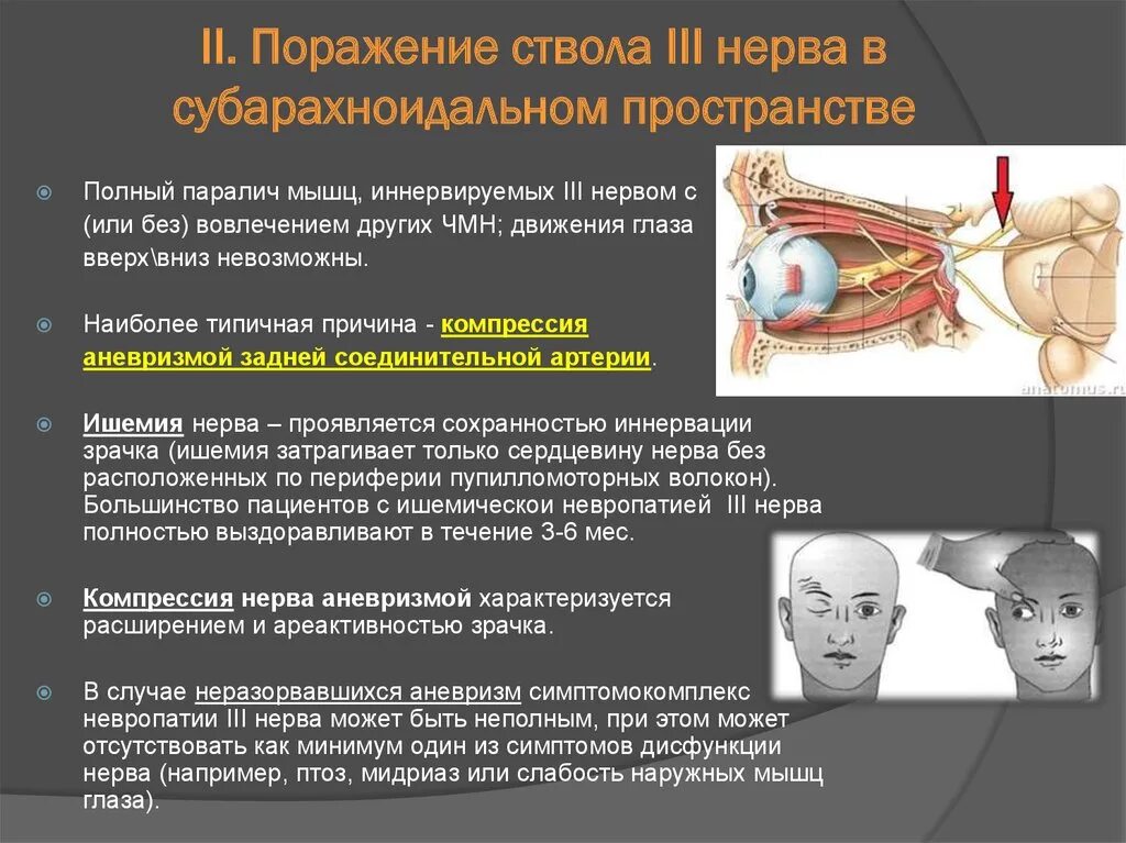 Поражение 3 нерва. Симптомы поражения глазодвигательных нервов (III, IV, vi).. Поражение ствола глазодвигательного нерва. Поражение нервных стволов симптомы. Симптомы поражения отводящего нерва.