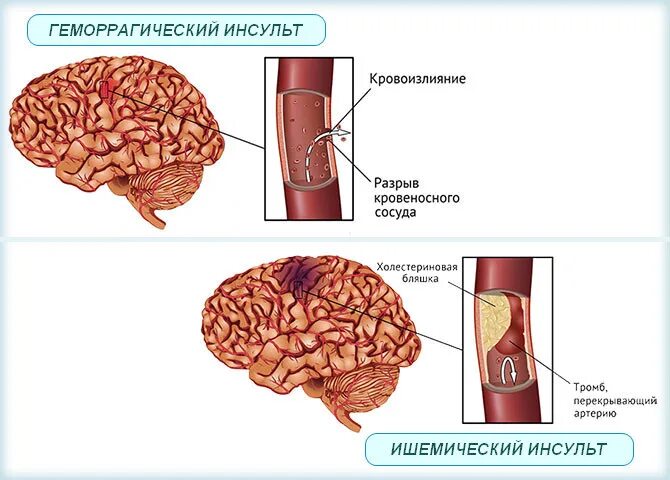 Геморрагический инсульт и ишемический инсульт. Инсульт геморогич ишемич. Подострый геморрагический инсульт. Геморрагический инсульт схема.