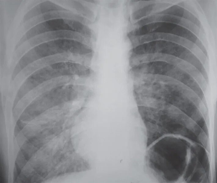 пневмония матовое стекло что это. двухсторонняя интерстициальная пневмония кт1. коронавирус на кт легких матовое стекло. рентген легких полисегментарная пневмония. матовое стекло в легких.