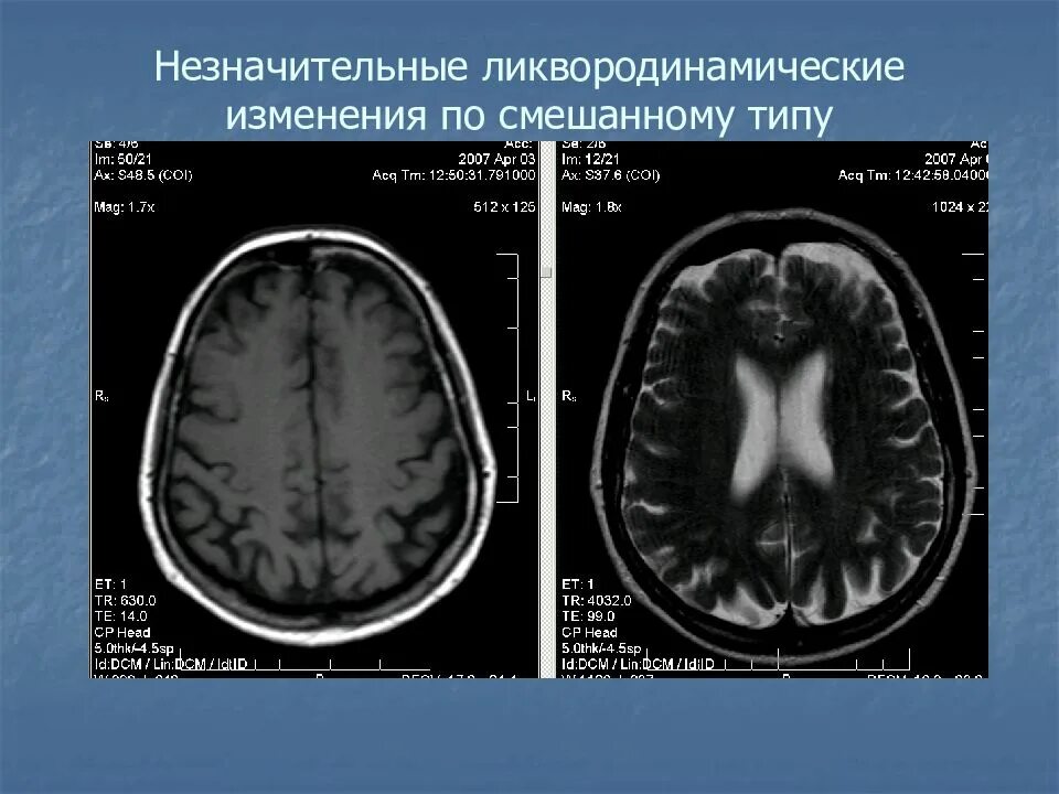 Гидроцефалия головного мозга на кт. Наружная гидроцефалия головного мозга кт. Заместительная наружная гидроцефалия кт. Выраженная наружная и внутренняя гидроцефалия.