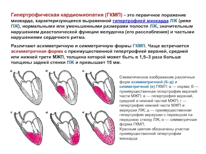 Миокард правого желудочка сердца. Классификация гипертрофии миокарда левого желудочка. Гипертрофия желудочка сердца. Асимметричная гипертрофия межжелудочковой перегородки характерна. Кардиомиопатия гипертрофия левого желудочка.