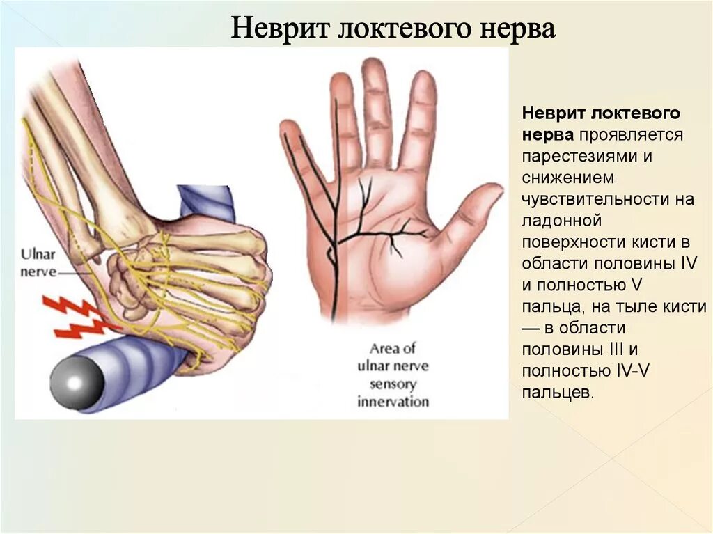 Неврит (невропатия) локтевого нерва.. Невропатия локтевого нерва симптомы. Нейропатия локтевого и лучевого нерва. Нейропатия локтевого нерва синдром. Нейропатия локтевого мкб