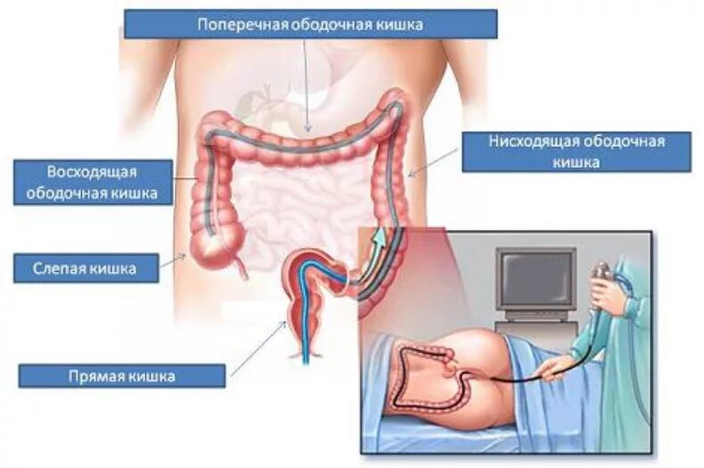 Исследование прямой и сигмовидной кишки. Колоноскопия ободочной кишки. Обследование кишечника колоноскопия. Колоноскопия слепой кишки. Эндоскопическое исследование толстой кишки колоноскопия.
