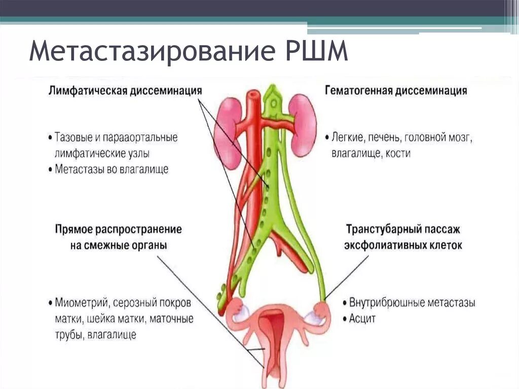 Регионарные лимфатические узлы шейки матки. Отдаленные метастазы РШМ. Метастазы при онкологии матки. РШМ куда дает метастазы.