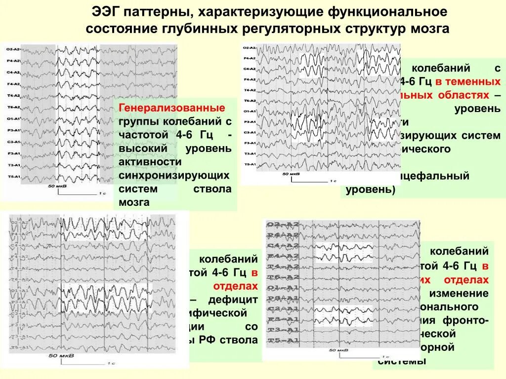 Регистрация ээг. Паттерны ЭЭГ. ЭЭГ нормальные показатели. Энцефалограмма головы нормальные показатели. Особенности электроэнцефалограммы у детей.