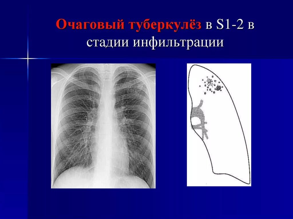 Фазы очагового туберкулеза