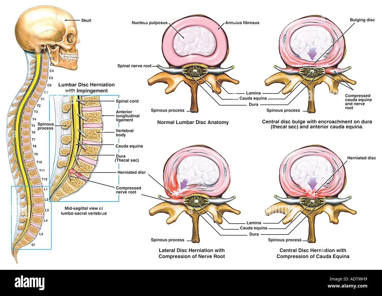 L5 s1 схема позвоночника. Lumbar Disk nomenclature 2.0. Позвонок нуклеус.