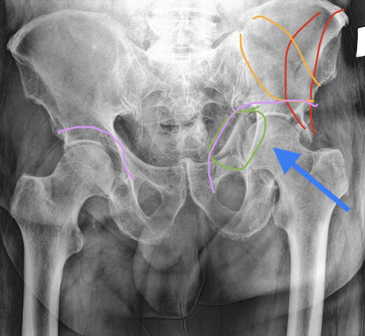 Перелом костей таза рентгенограмма. Подвздошная кость рентген анатомия. Перелом тазовой кости рентген. Вертлужная впадина тазовой кости рентген.