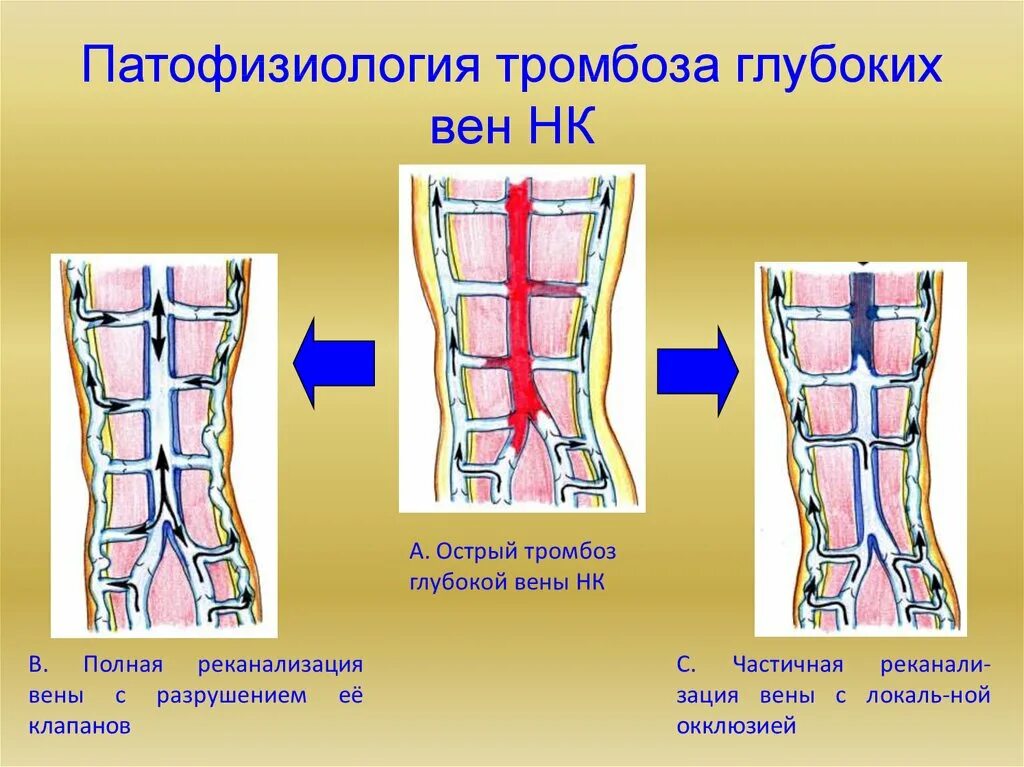 Реканализация тромбоза глубоких вен. Острый тромбоз глубоких вен нижних конечностей. Тромбоз глубоких вен классификация. Классификация венозных тромбозов. Формы тромбозов