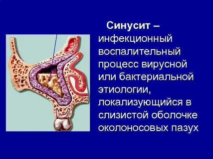Вирусный гайморит
