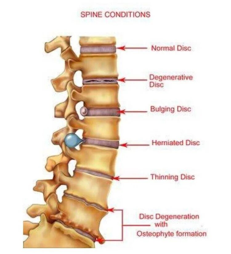 Остеофиты что это такое и как лечить. Задние остеофиты позвонков поясничного отдела. Задние остеофиты позвонков с4-с5. Задние остеофиты l4-s1. Краевые остеофиты позвонков поясничного отдела.