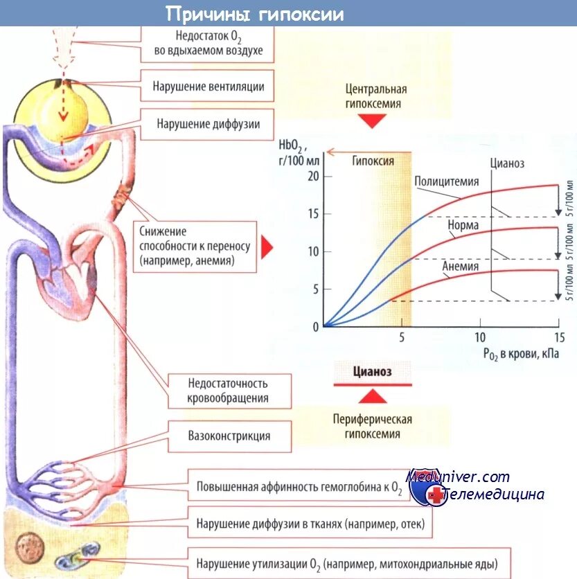 Экстренная гипоксия. Патофизиология гипоксии и гипероксии. Гипоксия схема. Механизм развития респираторной гипоксии. Механизм возникновения гипоксии.