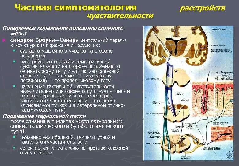 Латеральный спинно-таламический путь. Боковой спинно таламический путь. Синдром поражения половины спинного мозга. Поражение болевой и температурной чувствительности.