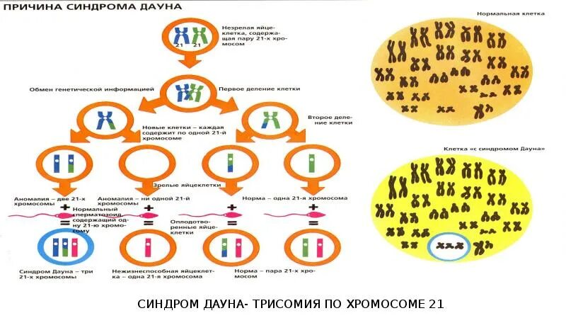 Синдром Дауна 21 хромосома. Синдром Дауна трисомия 21 хромосомы. Синдром Дауна схема хромосом. Синдром Дауна геномная мутация. Синдром дауна механизм