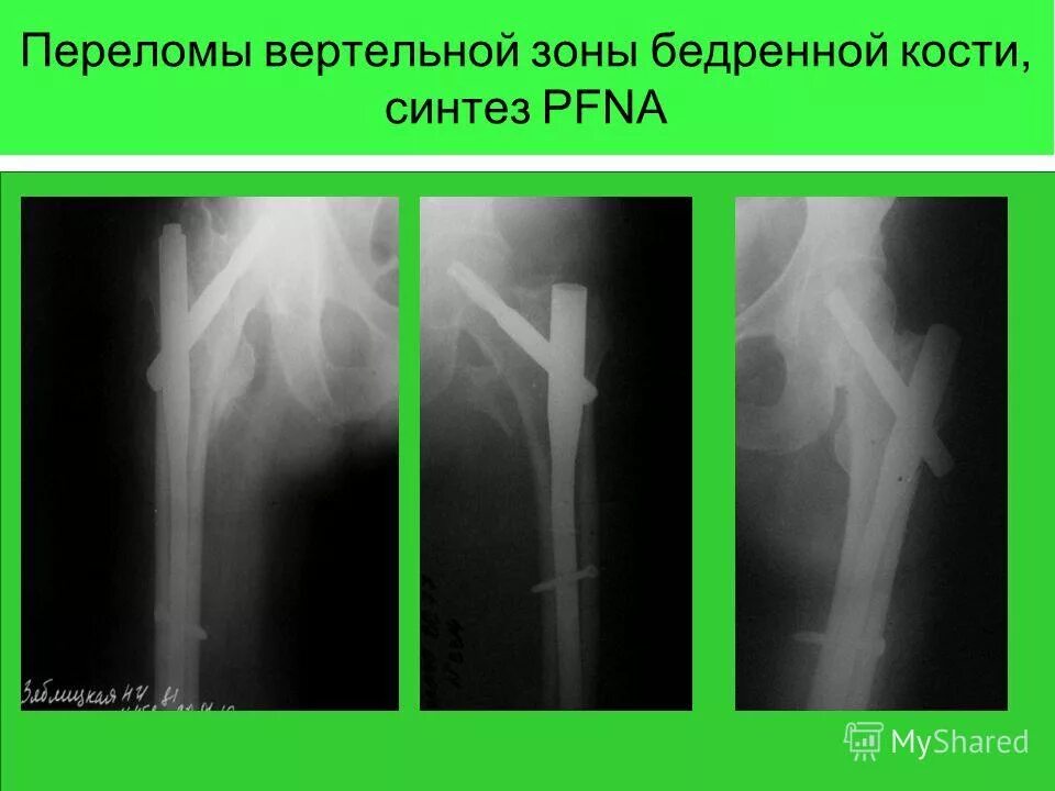 Через перелом бедра. Через вертельная перелом бедра. вертельные переломы бедренной кости. остеосинтез чрезвертельного перелома бедренной кости. вертельный перелом тазобедренного сустава.