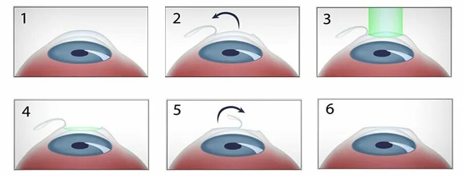 Ласик (LASIK)/Фемто ласик (Femto LASIK). Лазерная коррекция зрения Femto LASIK. LASIK лазерный кератомилез. Этапы лазерной коррекции зрения ласик. Коррекция зрения какие методы