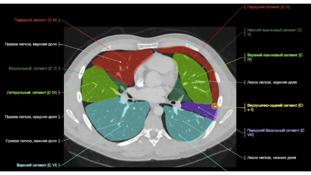 Доли легкого на кт. Сегментарное строение легких на кт. Кт сегменты легких Сагиттальный срез. Язычковые сегменты легких кт. Доли и сегменты легких на кт.