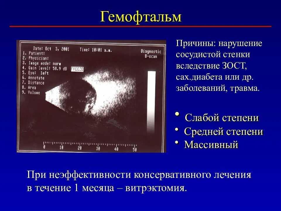 Деструкции стекловидного тела код мкб