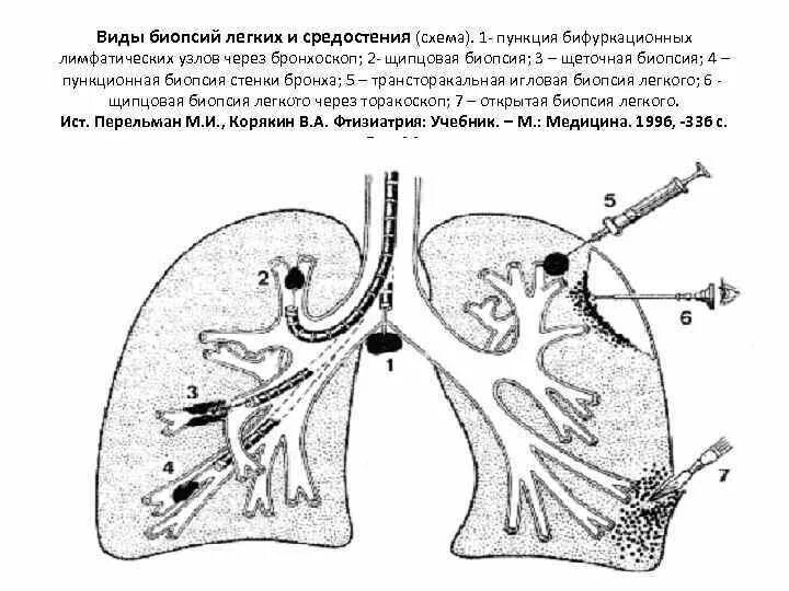 Как делают биопсию легких. Пункционная биопсия легких. Трансторакальная пункция средостения. Медиастинальная пункция. Лимфоузлы средостения биопсия.