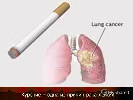 Рак легких причины