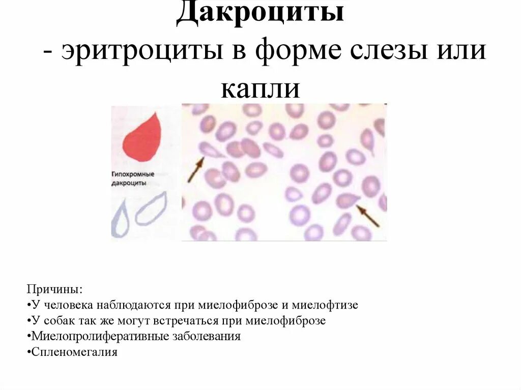 Эритроциты форма постоянная. Форма эритроцитов. патологические эритроциты. разновидность форм эритроцитов. классификация эритроцитов по форме.