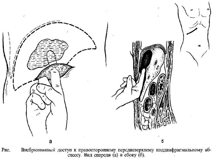 При передневерхней локализации абсцесс формируется. Абсцесс забрюшинного пространства кт. дренирование забрюшинного абсцесса. пункция поддиафрагмального абсцесса. поддиафрагмальный абсцесс.