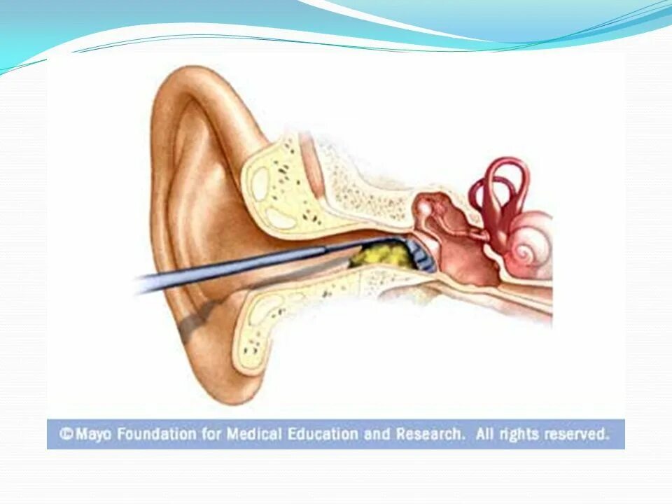 Ухо заложило после чистки палочкой. Строение уха серная пробка. Ухо строение серная пробка. Анатомия уха серная пробка. Кюретаж наружного слухового прохода.