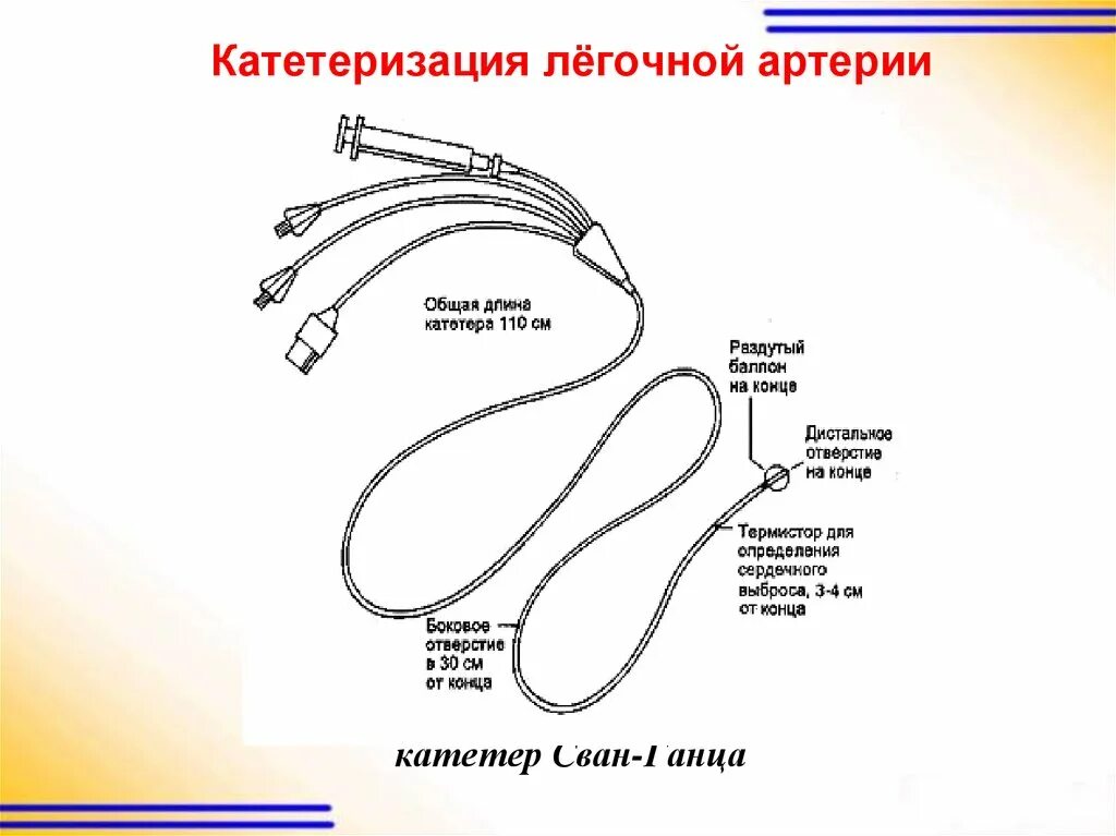 Внутренний катетер. Сванганс катетер. Катетеризация сердца легочная артерия. Катетер Сван-ганца. Катетер в легочной артерии.