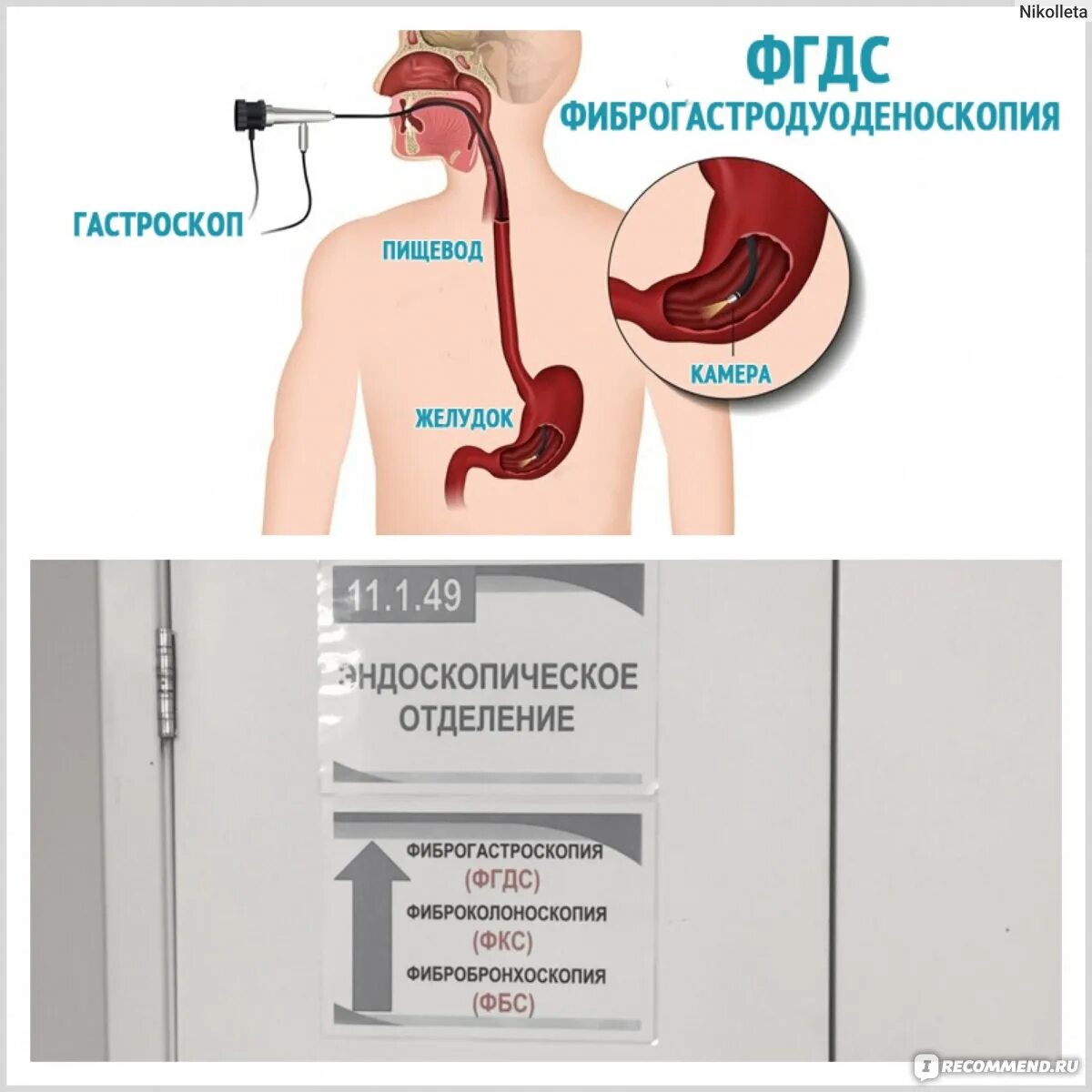 Гастроскопия. ФГДС желудка и двенадцатиперстной. Фгдм