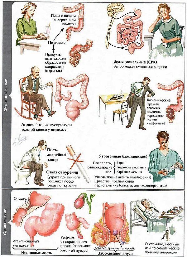 Запор у взрослого мужчины причины. Запоры у пожилых. Запор (медицина) симптомы. Органические и функциональные запоры. Гастроэнтерология с иллюстрациями Неттера.