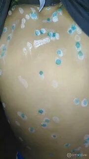 Чем мазать ребенка при ветрянке