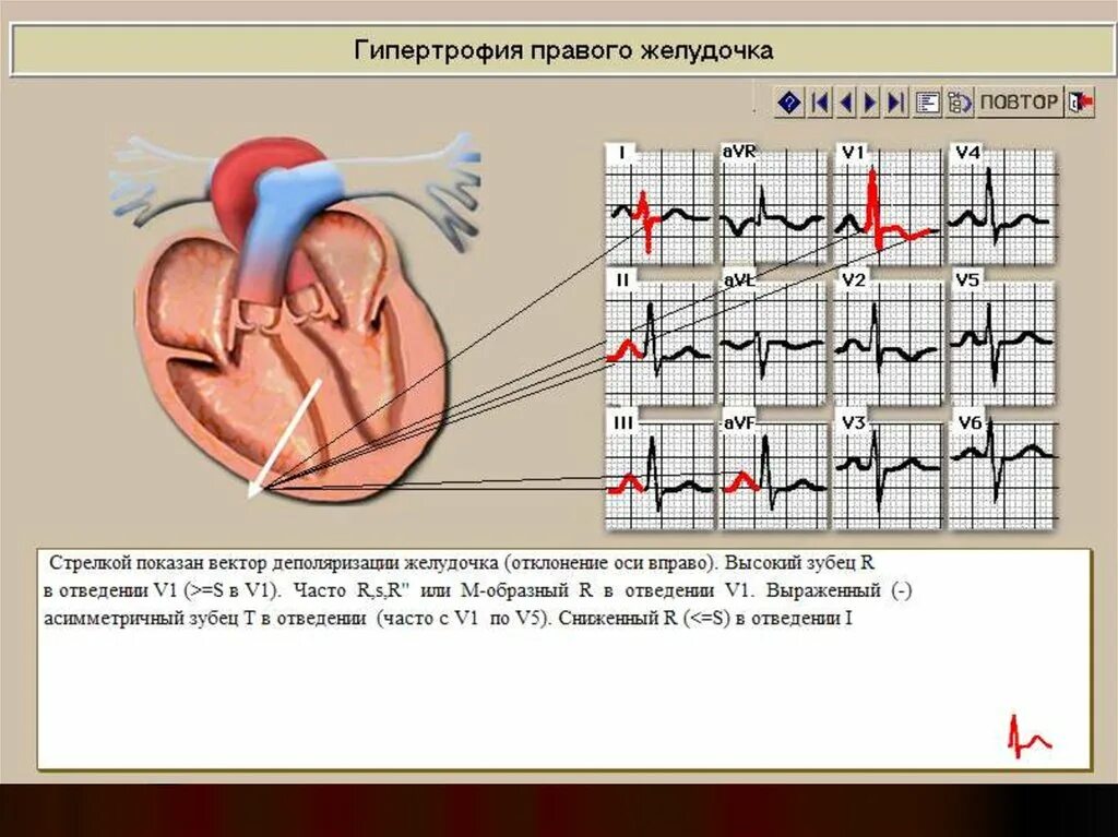 Типы гипертрофии левого желудочка. Гипертрофия миокарда левого предсердия на ЭКГ. Гипертрофия правого желудочка клинические. Гипертрофия правого желудочка схема. Гипертрофия левого предсердия левого желудочка