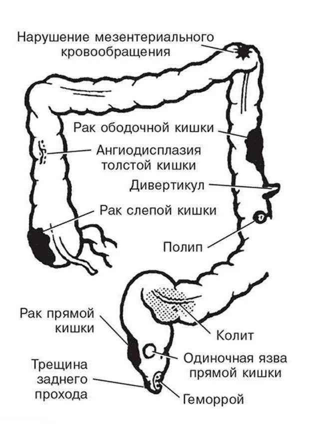 Боль при дефекации у мужчин причины. Опухоль сигмовидной кишки стадии. Лимфоузлы брыжейки толстой кишки. Дивертикулит слепой кишки. Внутри ободочной кишки.
