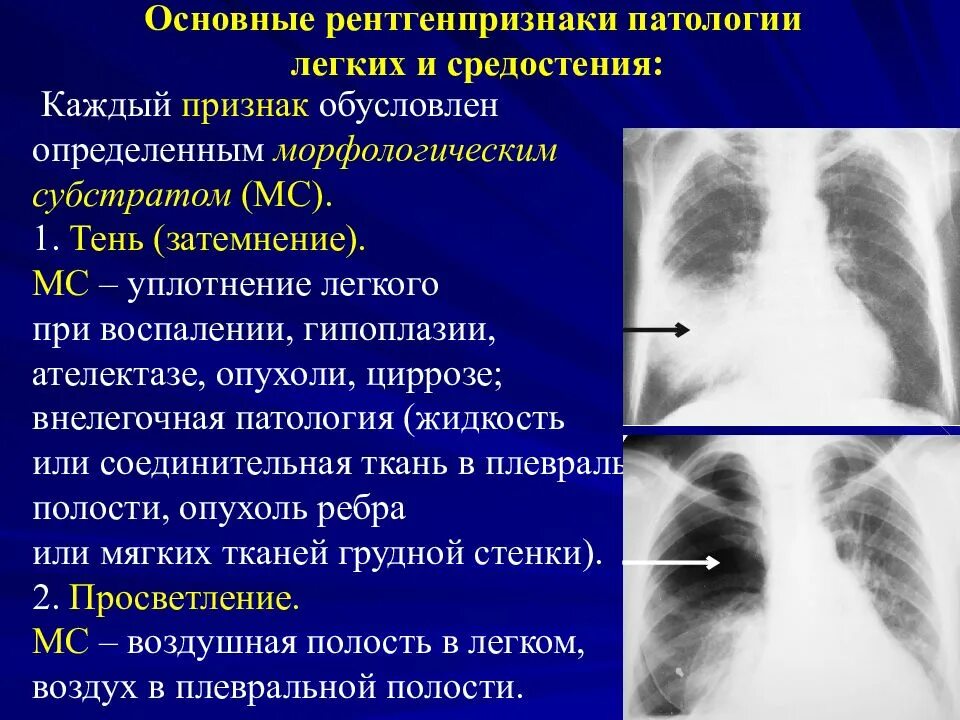 Затемнение в левом легком. Синдром уплотнения легочной ткани рентген. Синдром уплотнения легкого рентген. Синдром легочного уплотнения рентген. Уплотнение легочной ткани на рентгене.