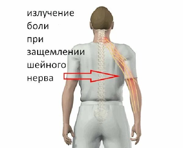 Защемило правую сторону шеи что делать. Шейный остеохондроз защемление нерва. Излучение боли при защемлении шейного нерва. Защемило шейный нерв симптомы. Области спины.