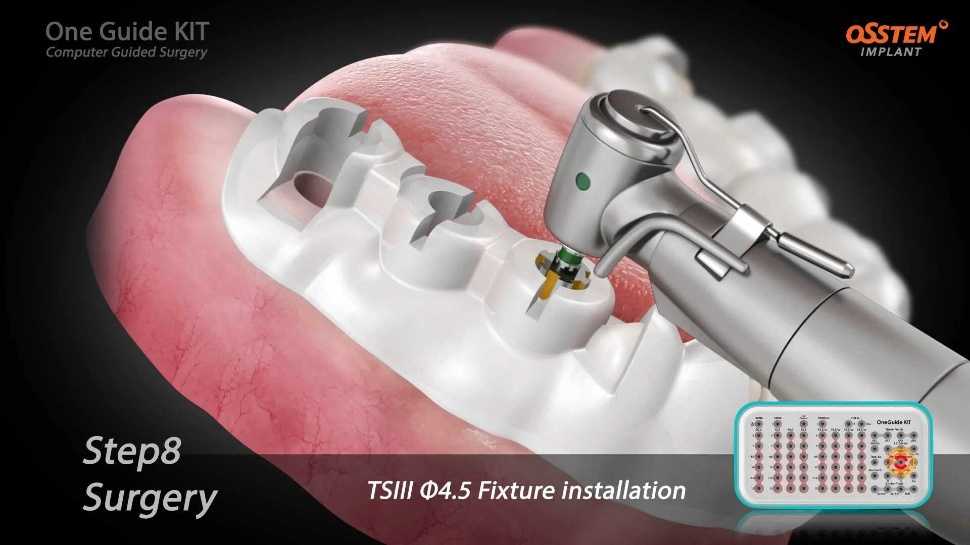 Имплантация sup aznona com. Навигационная имплантация зубов. Цифровая имплантация зубов. Шаблон для установки имплантатов.