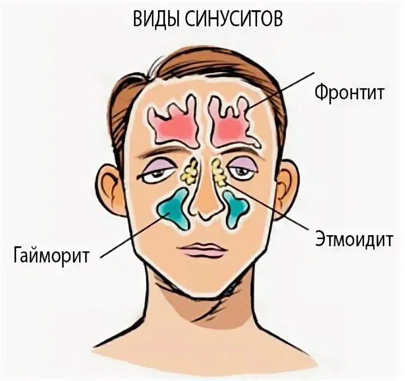 Прогревание пазух носа при насморке. Греть носовые пазухи. Носовые пазухи гайморит. Синусит прогревание пазух носа. Гайморовы пазухи гайморит.