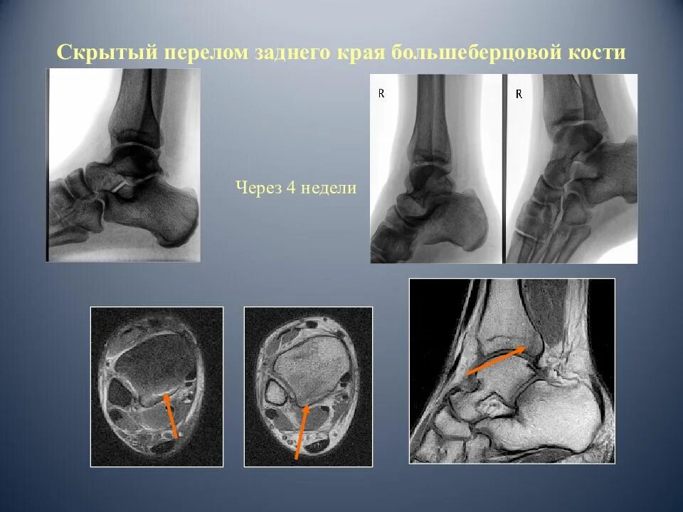 Перелом заднего. Перелом заднего края берцовой кости. перелом края большеберцовой кости. перелом заднего края большеберцовой кости.