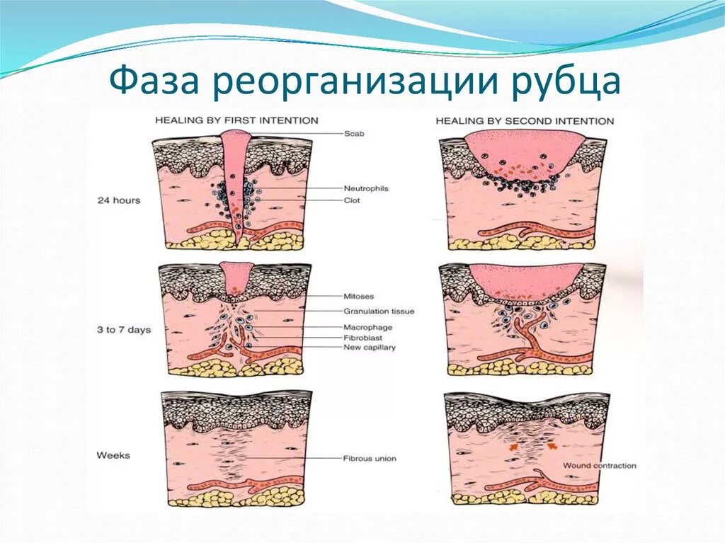 Фазы раневого процесса заживления РАН. Фазы заживления РАН схема. Стадии заживления рубца. Трещина заднего зажила