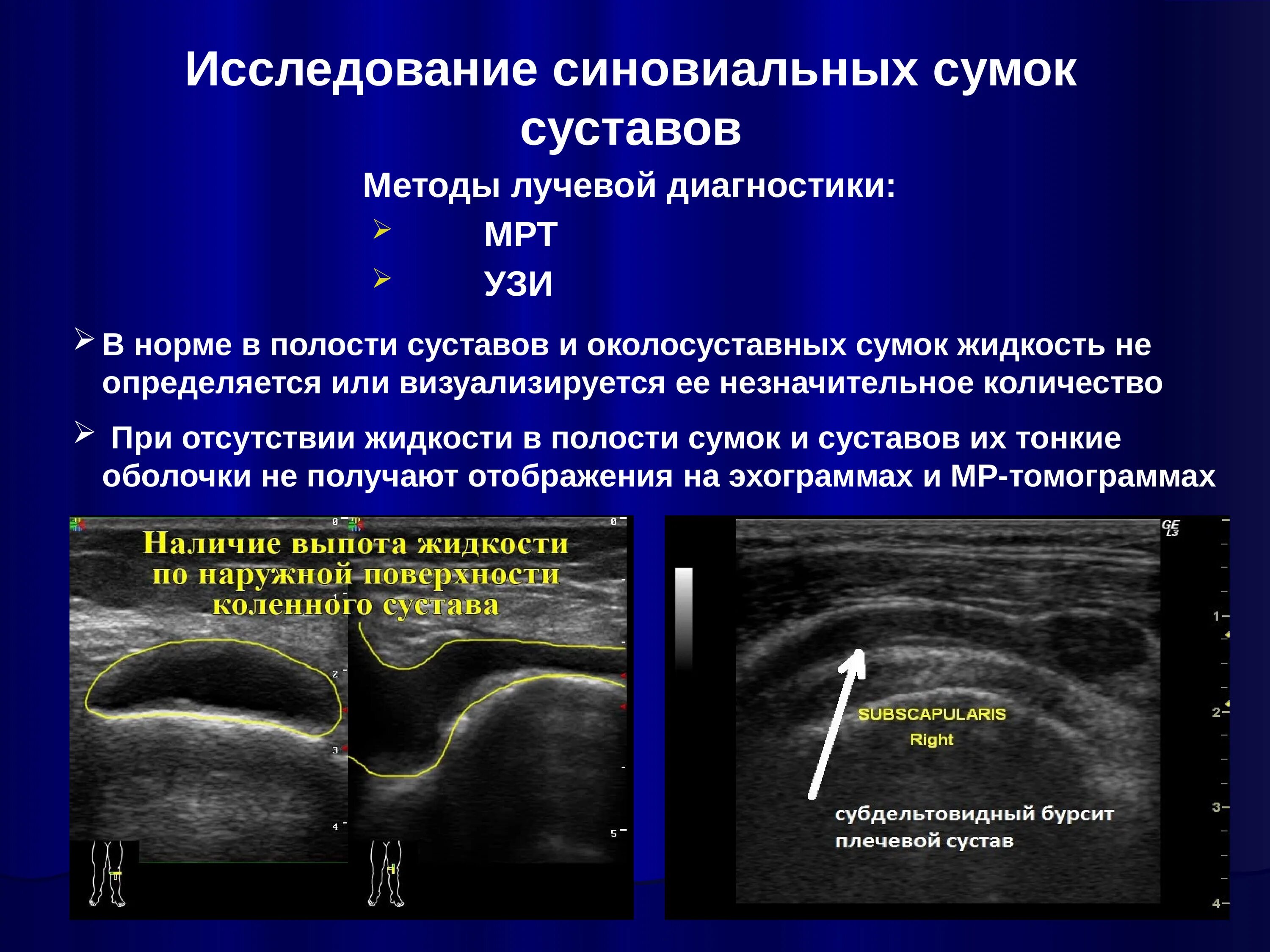 Выпот в полости коленного сустава. Протокол УЗИ плечевого сустава жидкость. Ультразвуковое исследование коленного сустава. Артроз на УЗИ коленного сустава. УЗИ коленного сустава методика.
