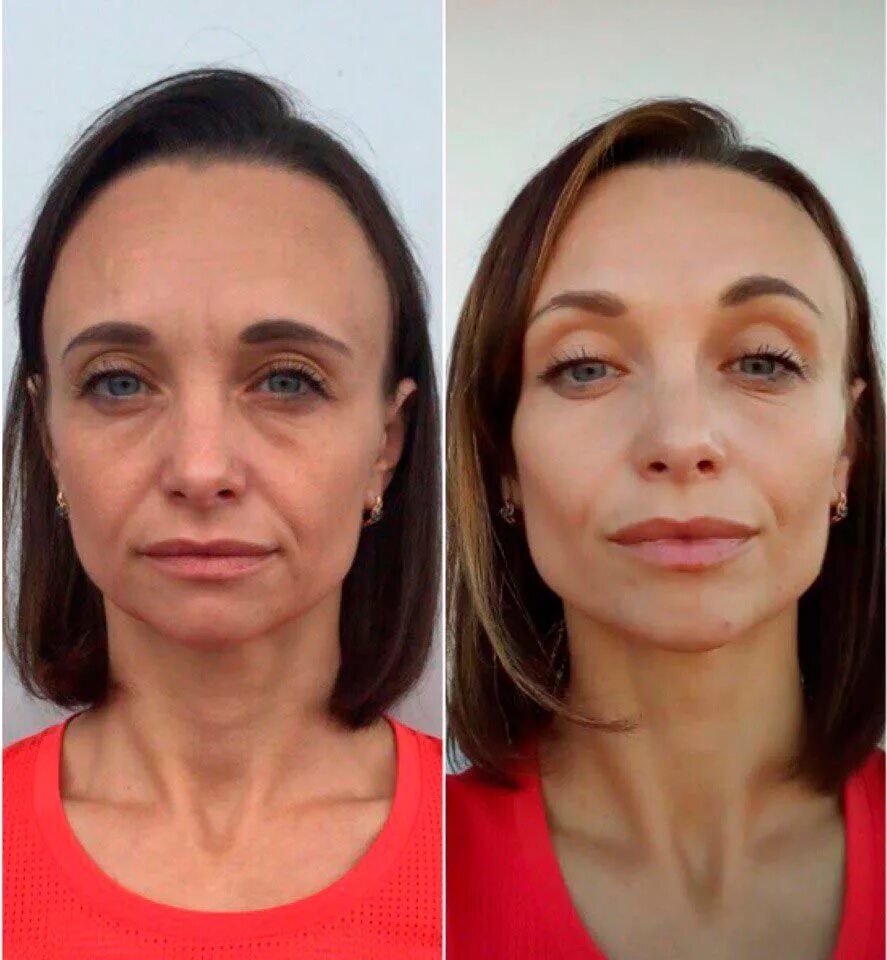 Контурная пластика лица skinlift. Фейсбилдинга Кэрол Мадджио. Массаж лица до и после. Объемное моделирование лица. Филеры в косметологии.