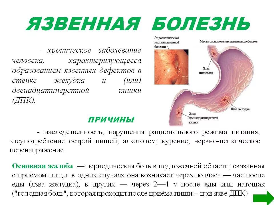 Язвенная болезнь желудка и 12 перстной. Обострение язвенной болезни желудка и 12-перстной кишки.. Жалобы при язвенной болезни желудка и 12-перстной кишки. Причины заболевания язвенной болезни желудка. Может ли от кишечника болеть желудок