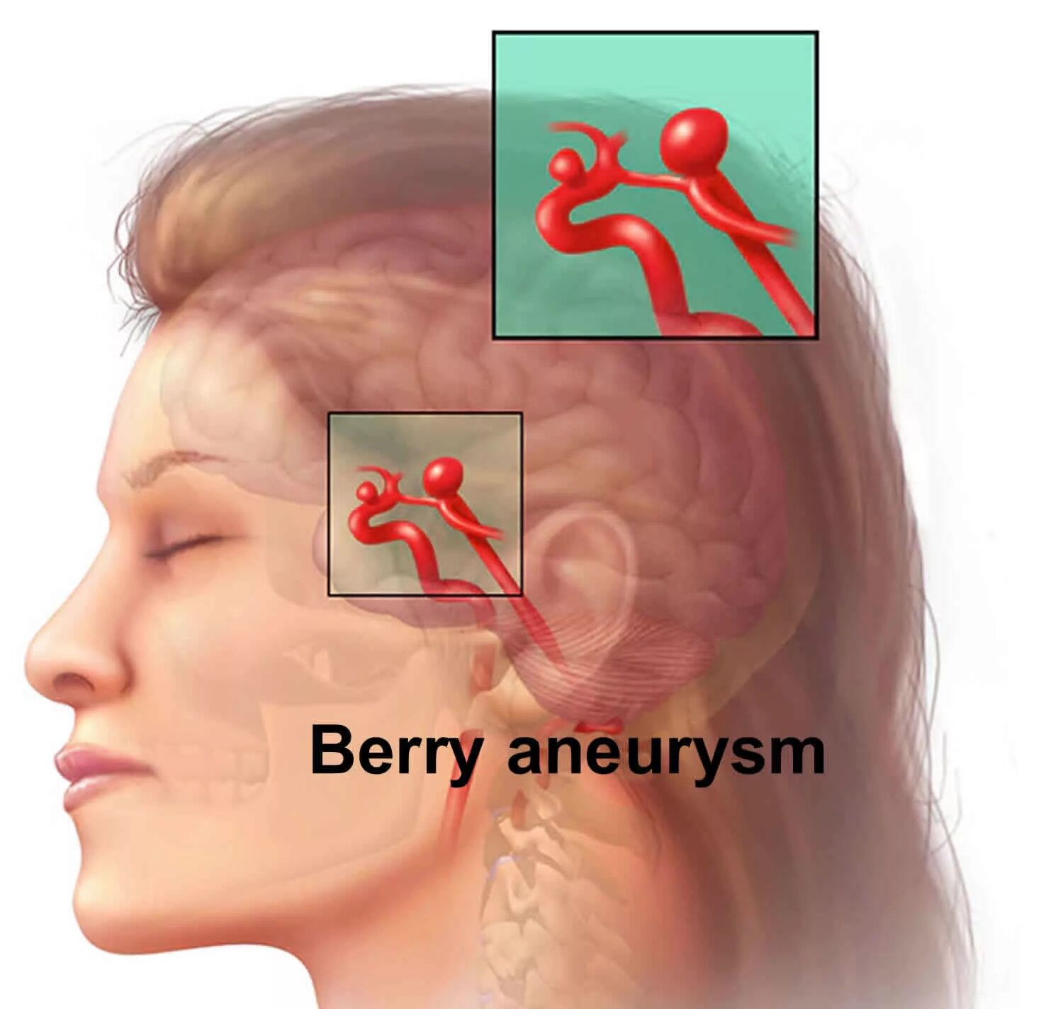 Головная боль сосуды головы. Аневризма сосудов головного мозга. Разрыв аневризма головного мозга. Аневризма сосудов головы. Расслаивающая аневризма головного мозга.