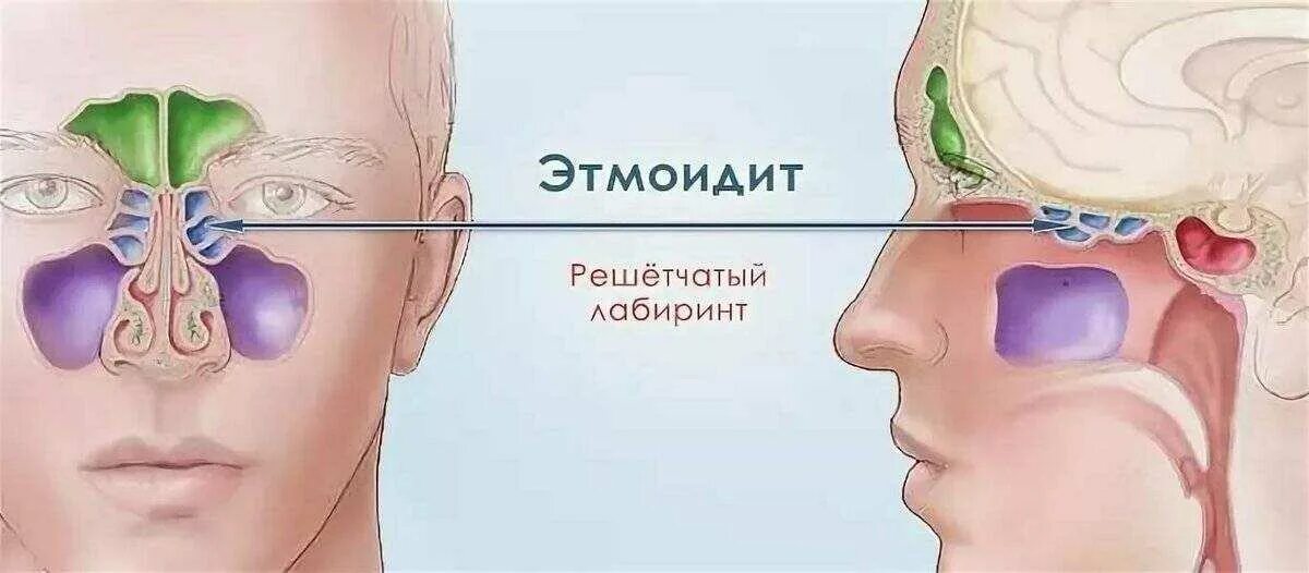 Хронический гайморит этмоидит фронтит. Хронический Гнойный этмоидит. Этмоидальный синусит симптомы. Правосторонний гнойный